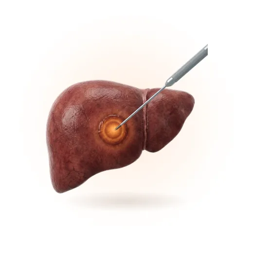 Microwave Ablation (MWA) for Liver Tumours illustration
