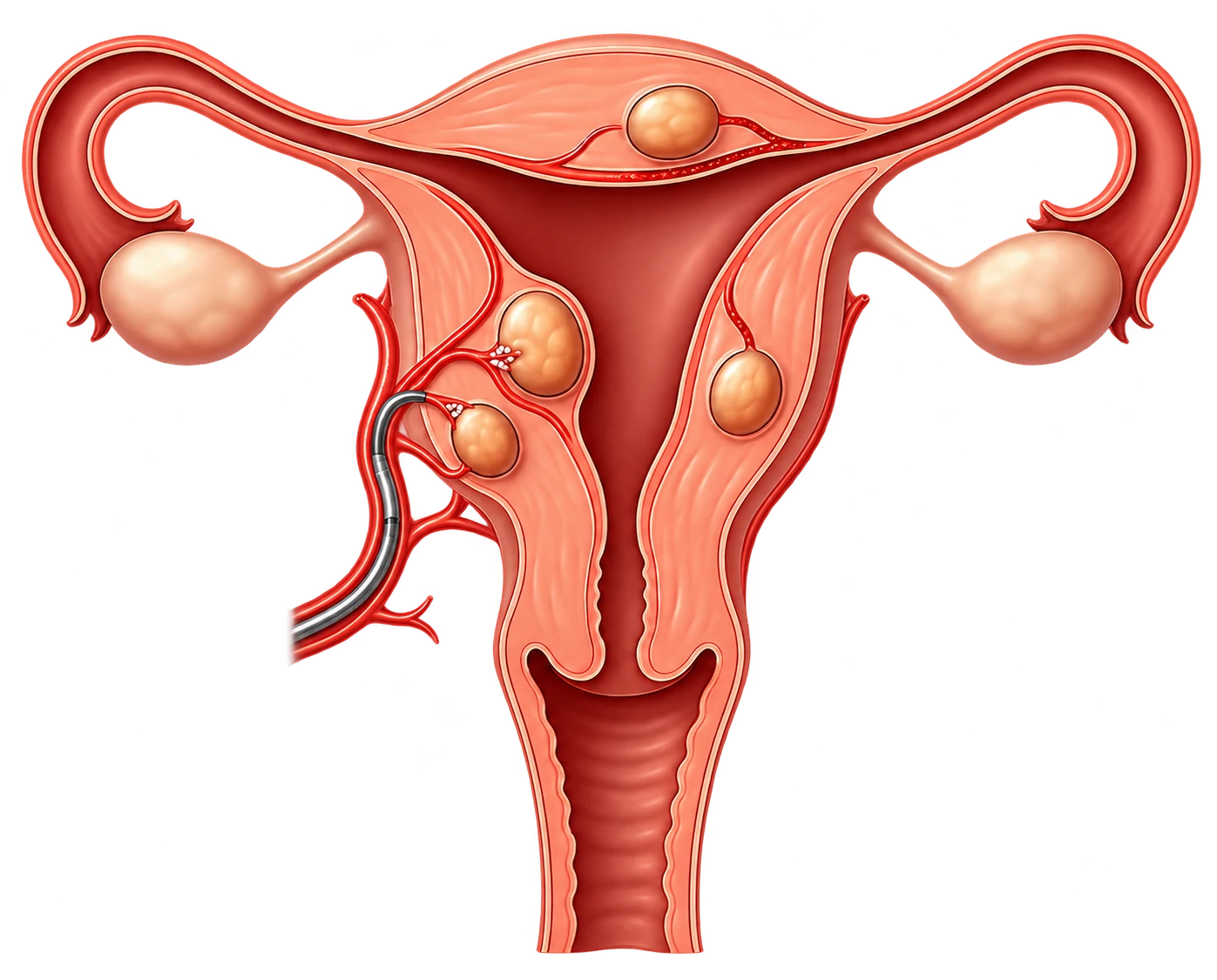 Uterine Fibroid Embolization (UFE) illustration