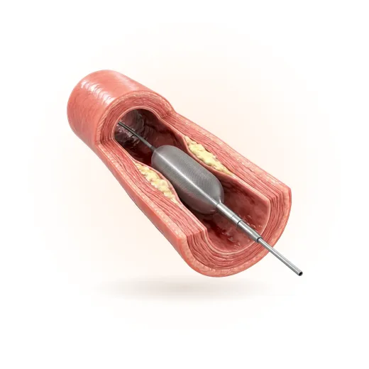 Peripheral Arterial Disease (PAD) illustration