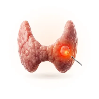 Thyroid Nodule Ablation & Embolization illustration