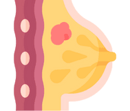 Breast Nodules