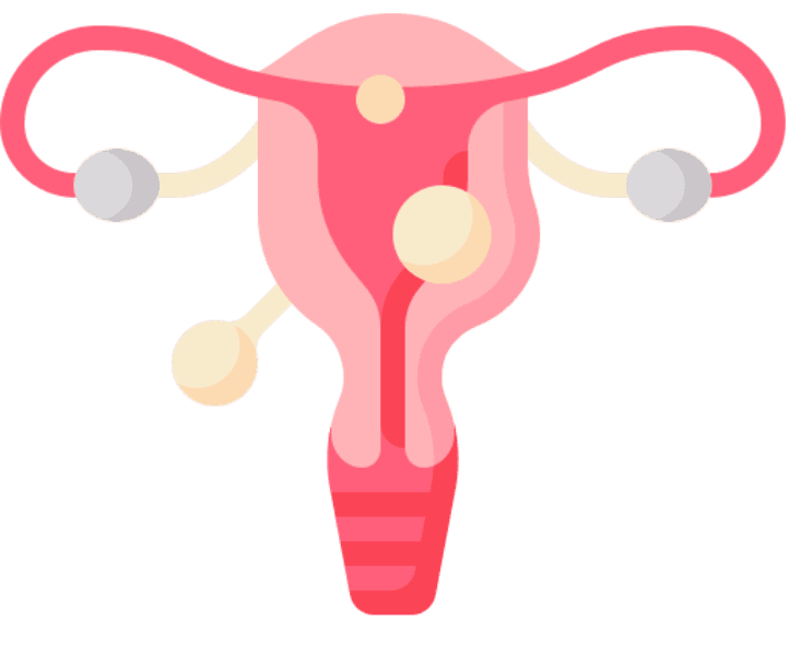 Fibroid & Adenomyosis