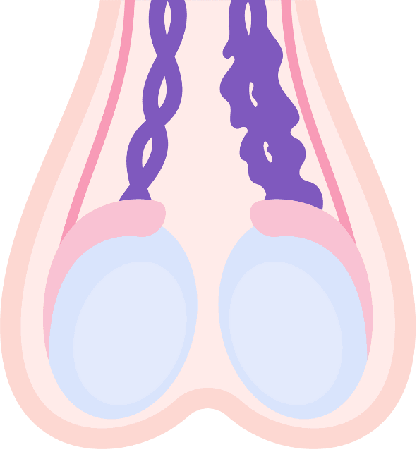 Varicocele Embolization