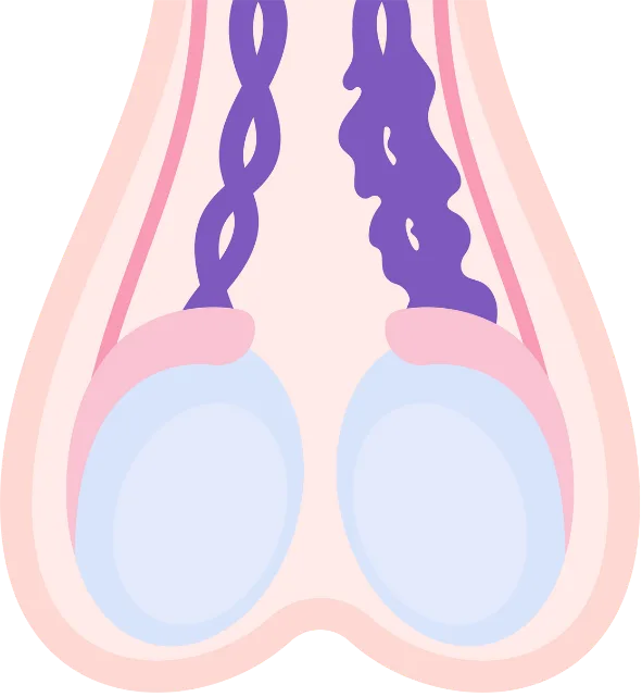 Varicocele Embolization