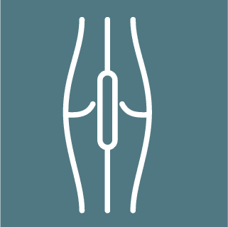Angioplasty