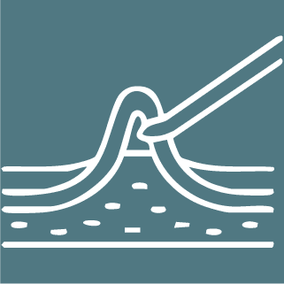 Ambulatory Phlebectomy