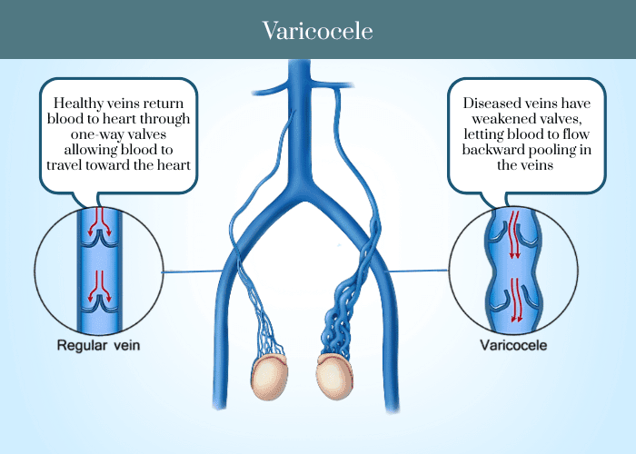 Varicocele Embolization