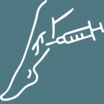 Sclerotherapy