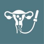 Uterine fibroid embolization is the best non surgical treatment for fibroids