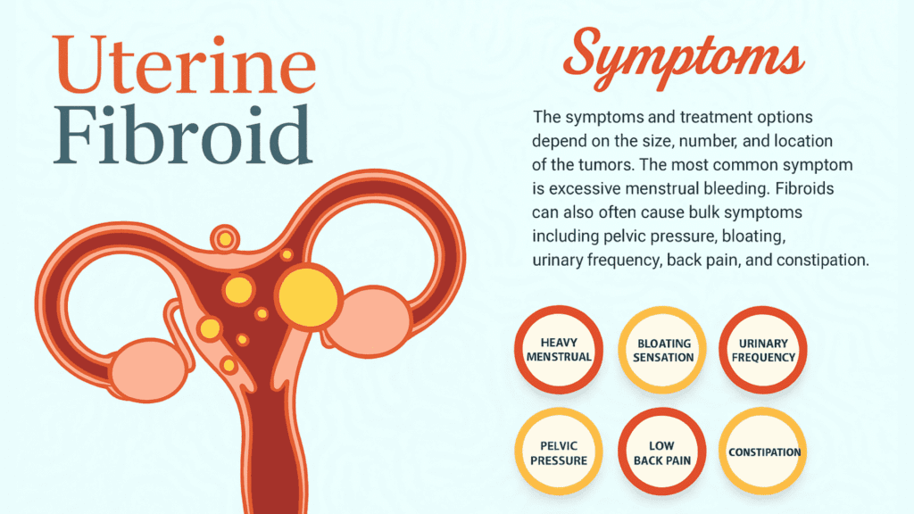 Uterine Fibroids