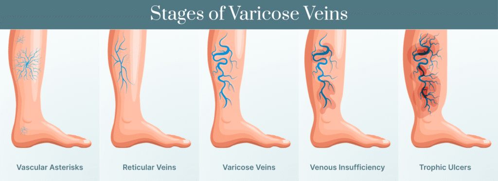 Stages of Varicose Veins