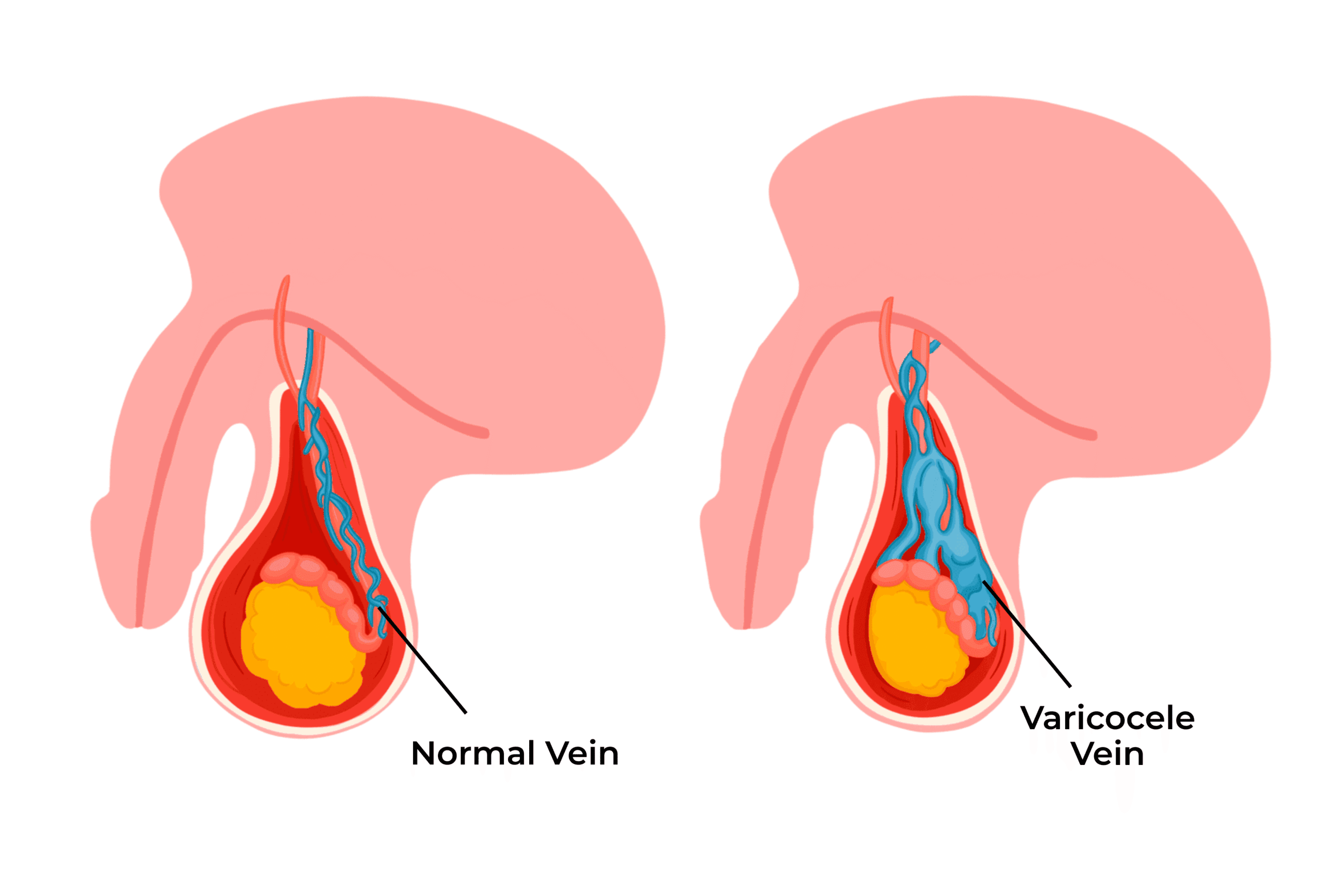 Varicocele_Embolization