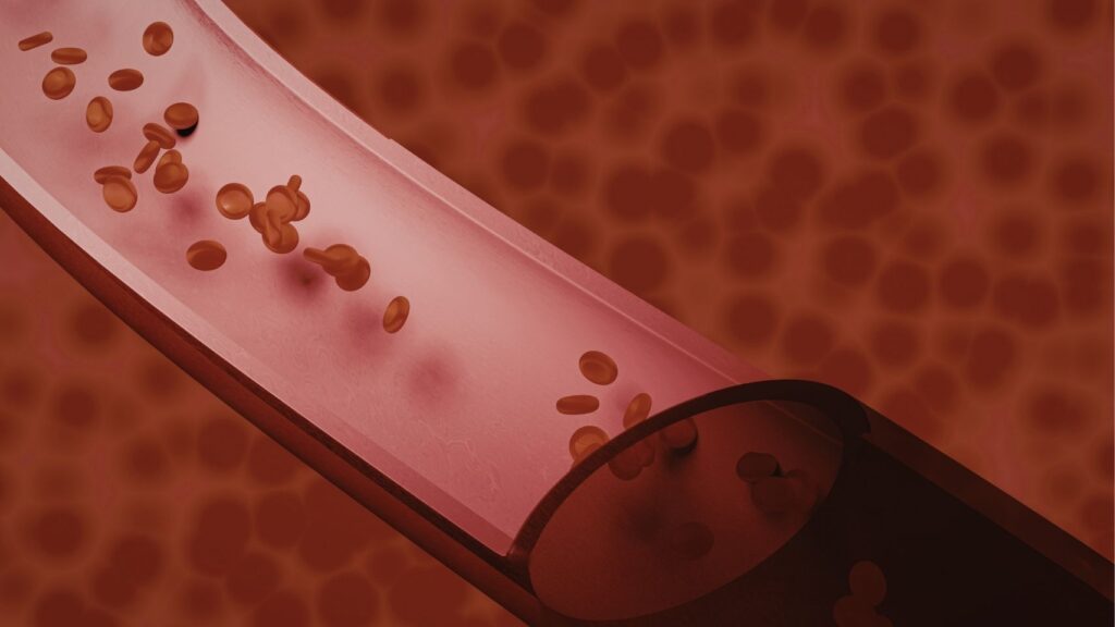 Varicocele Embolization