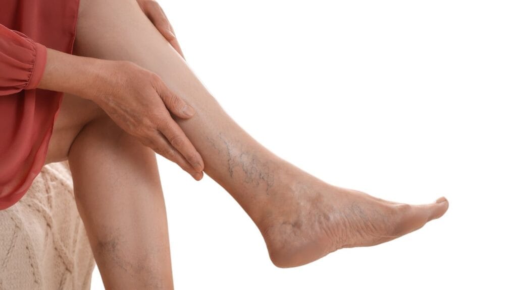  Varicose Veins 